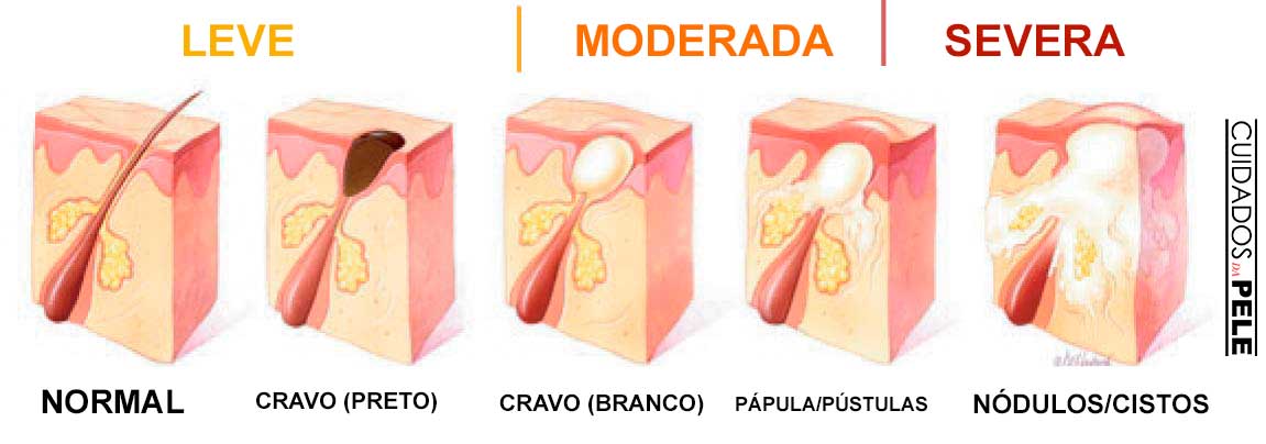 Entenda as Diferenças Entre Cravo (Preto e Branco) e Milium • Argila Preta